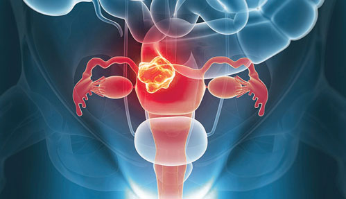 gynaecological-disorders 