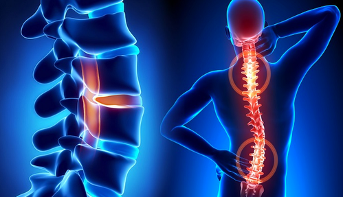 spine disorder